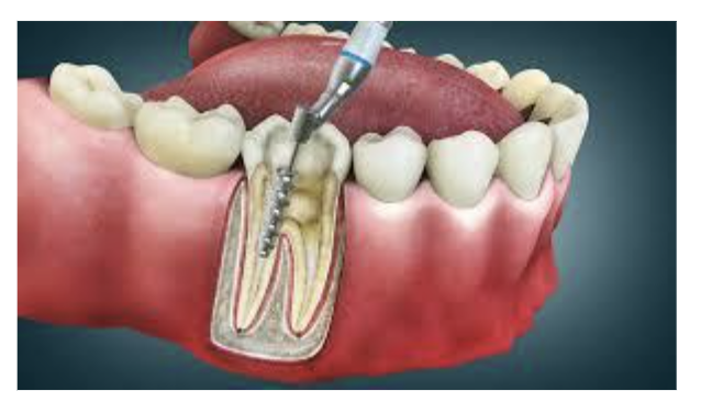 Root Canal Treatment in Bangalore